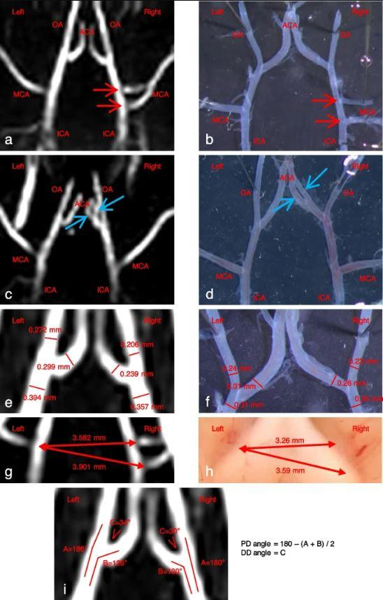采用飞行时间法和黑血MRI技术，利用美迪索nanoScan MRI 3T研究大鼠颅内动脉