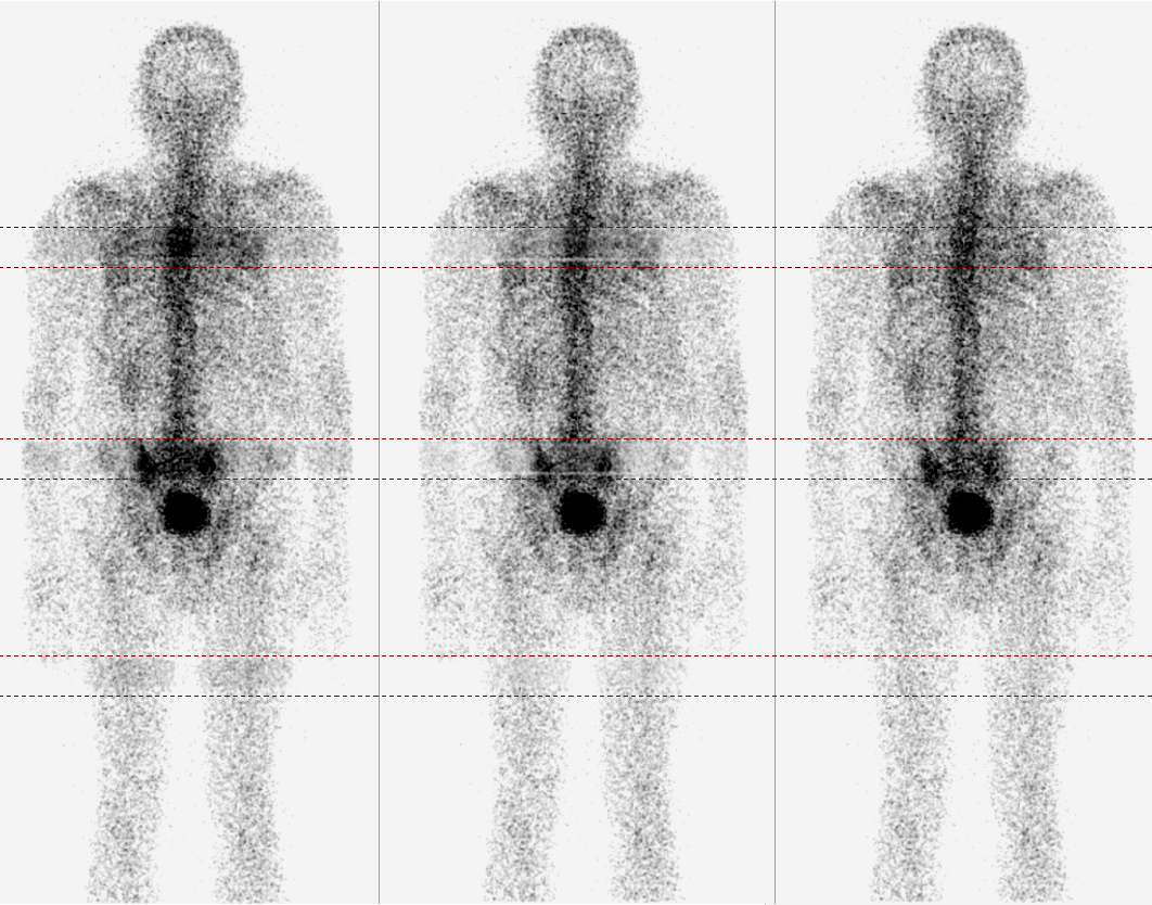 探索基于SPECT - CT的骨显像新工作流程和算法，携手Mediso美迪索AnyScan® DUO