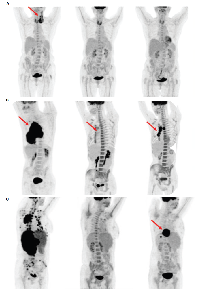 利用Mediso美迪索AnyScan® PET/CT，基于体内放射组学和临床参数精准预测DLBCL患