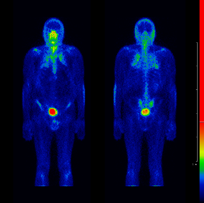探索基于SPECT - CT的骨显像新工作流程和算法，携手Mediso美迪索AnyScan® DUO